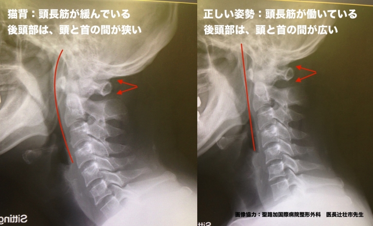 ストレートネックが起こるメカニズムについて ｜ KIZUカイロプラクティック整体本院